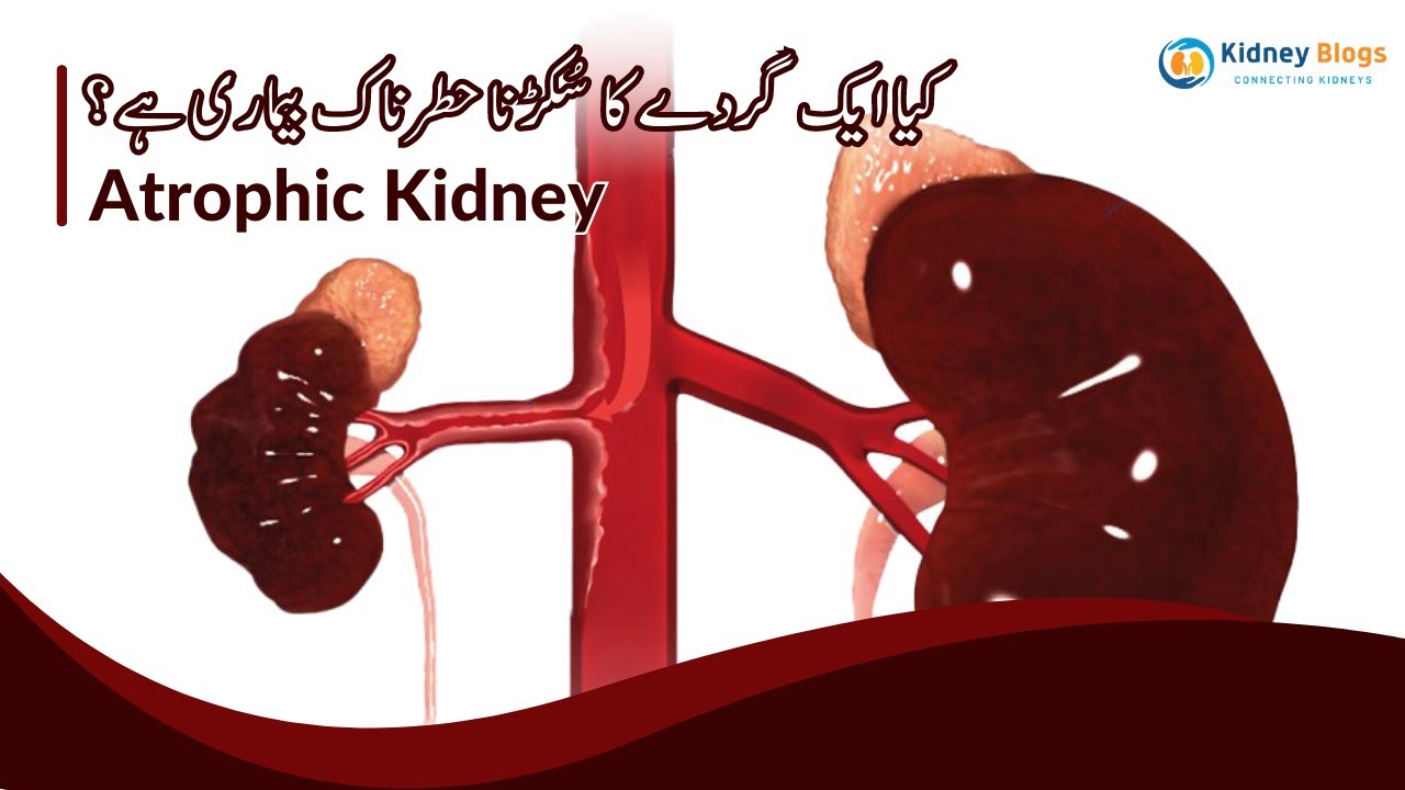 Atrophic Kidney | Ak Gurday Ka Chota Hona Causes, Symptoms, Diagnosis, Treatment | Urdu| Episode 53