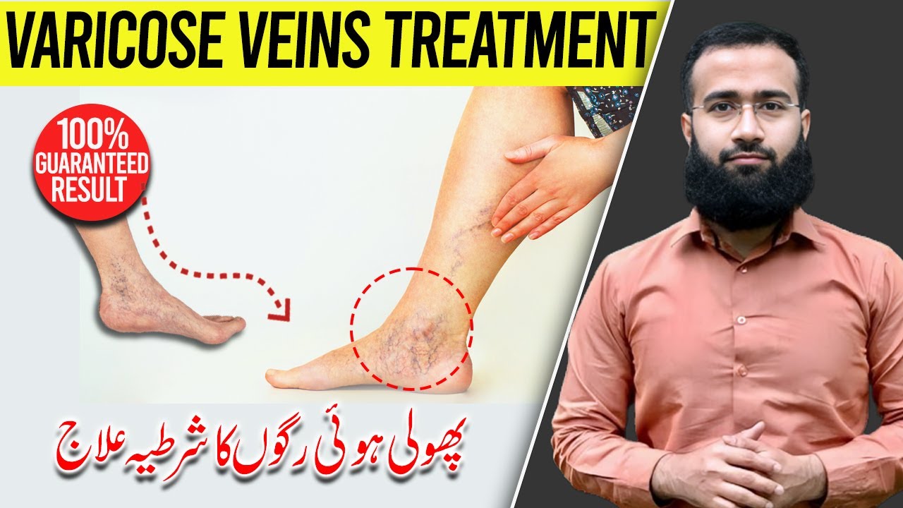 Varicose Veins Treatment | Spider Veins Exercises | Permanent Results