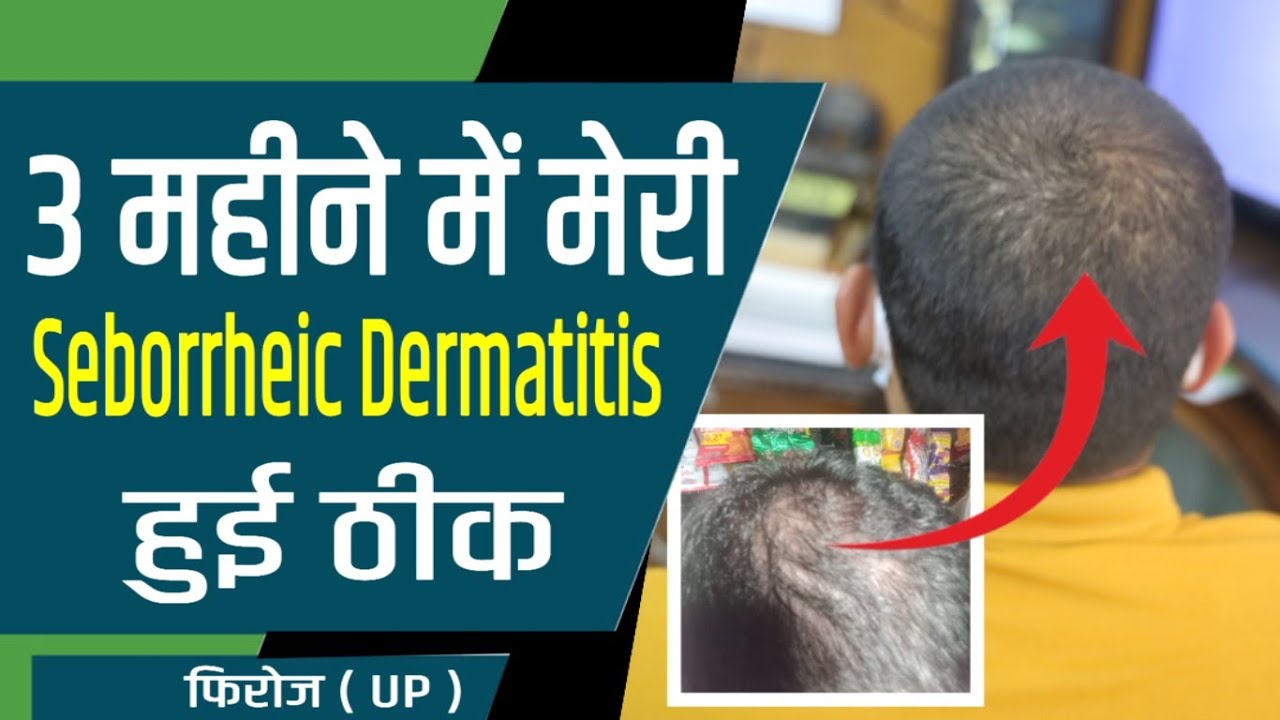 3 महीने में मेरी Seborrheic Dermatitis हुई ठीक -  फिरोज | My Oily Dandruff Cured - Feroz