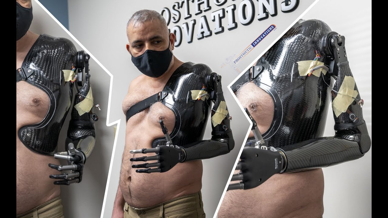 Shoulder Disarticulation Prosthesis | Steeper Espire Pro | I-limb Quantum | Prosthetic Innovations