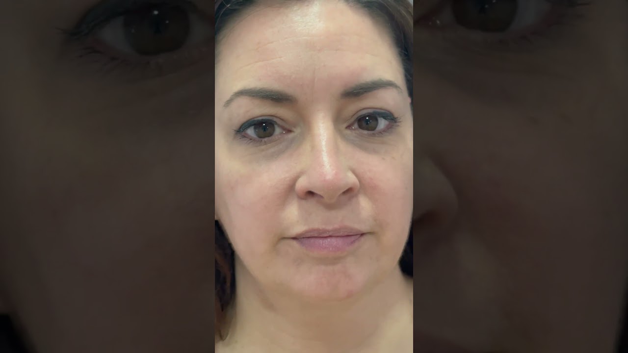 Rinoplastia cerrada antes y después