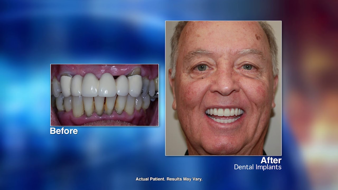 Dental Implants with Dr  Henninger