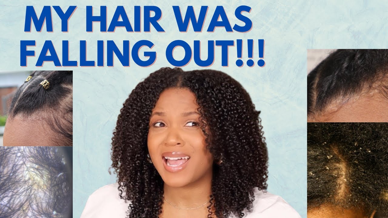 My struggles with DRY/FLAKY SCALP (Seborrheic Dermatitis) and how I addressed it | Exotik_Roots