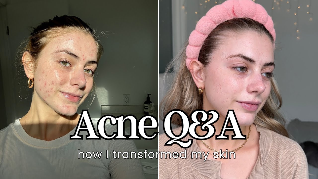 My Journey to Clear Skin | Overcoming Acne | Q&A