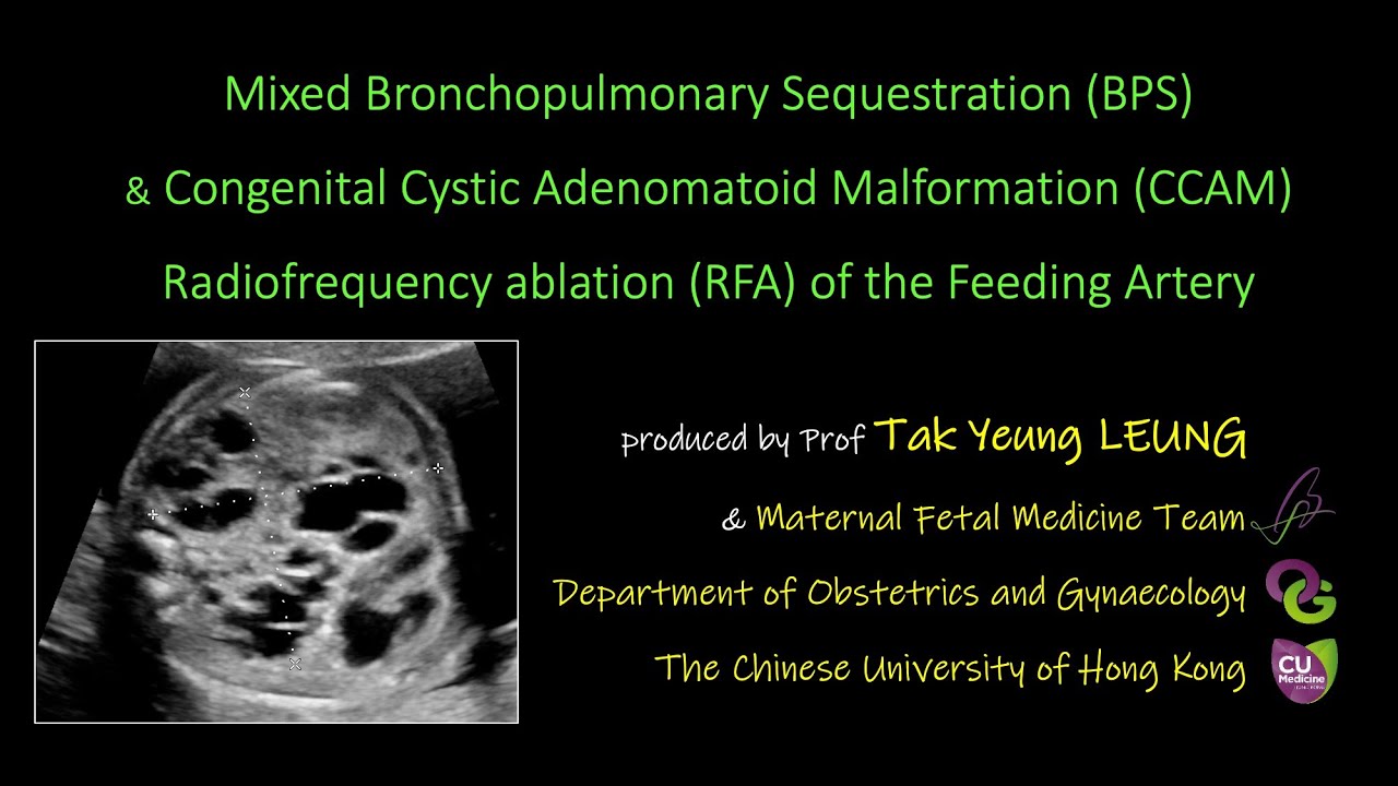 Mixed Bronchopulmonary Sequestration & Congenital Cystic Adenomatoid Malformation RFA
