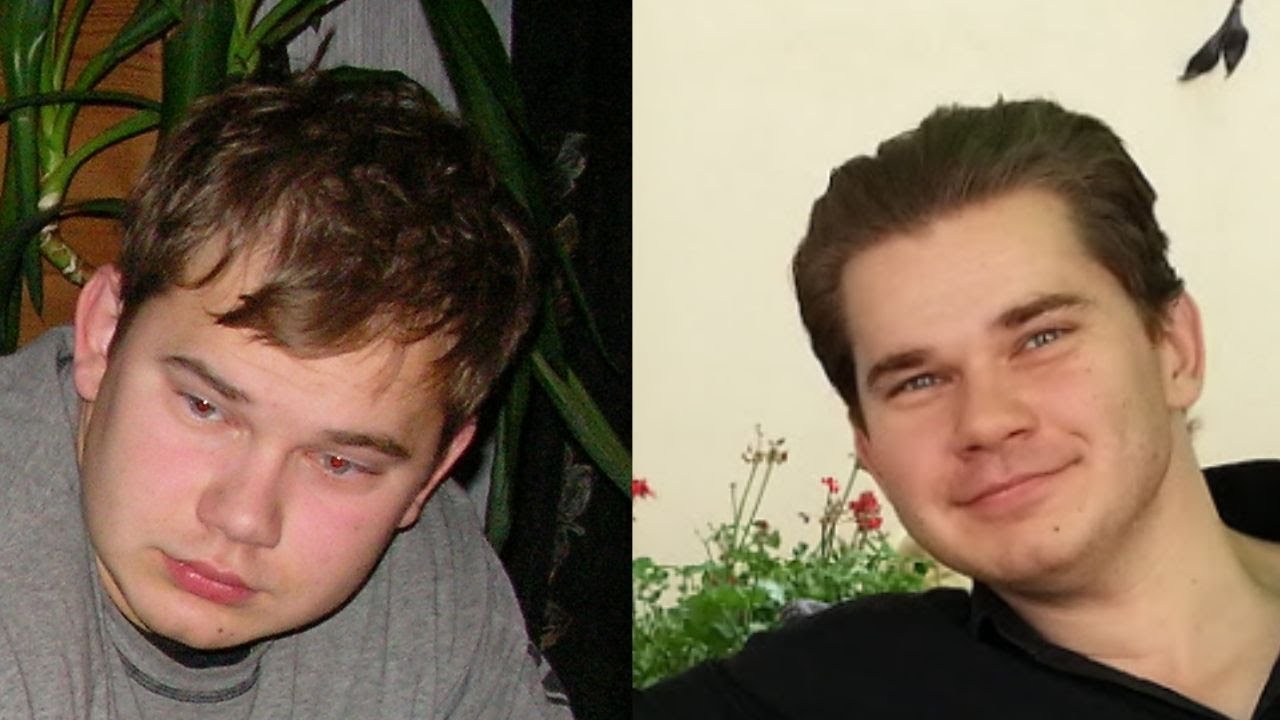 Hair Miniaturization How To Tell And How Does It Look Like