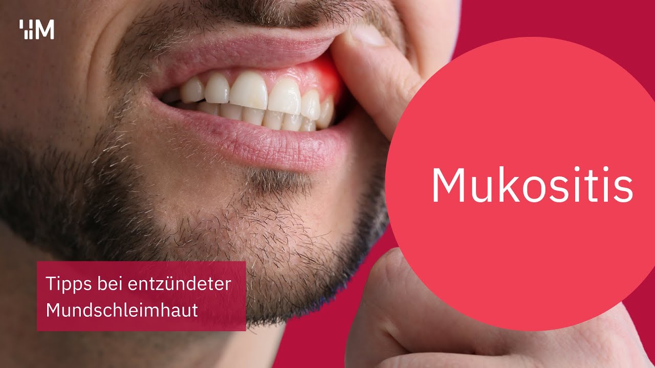 Mukositis: Tipps bei entzündeter Mundschleimhaut durch die Krebstherapie