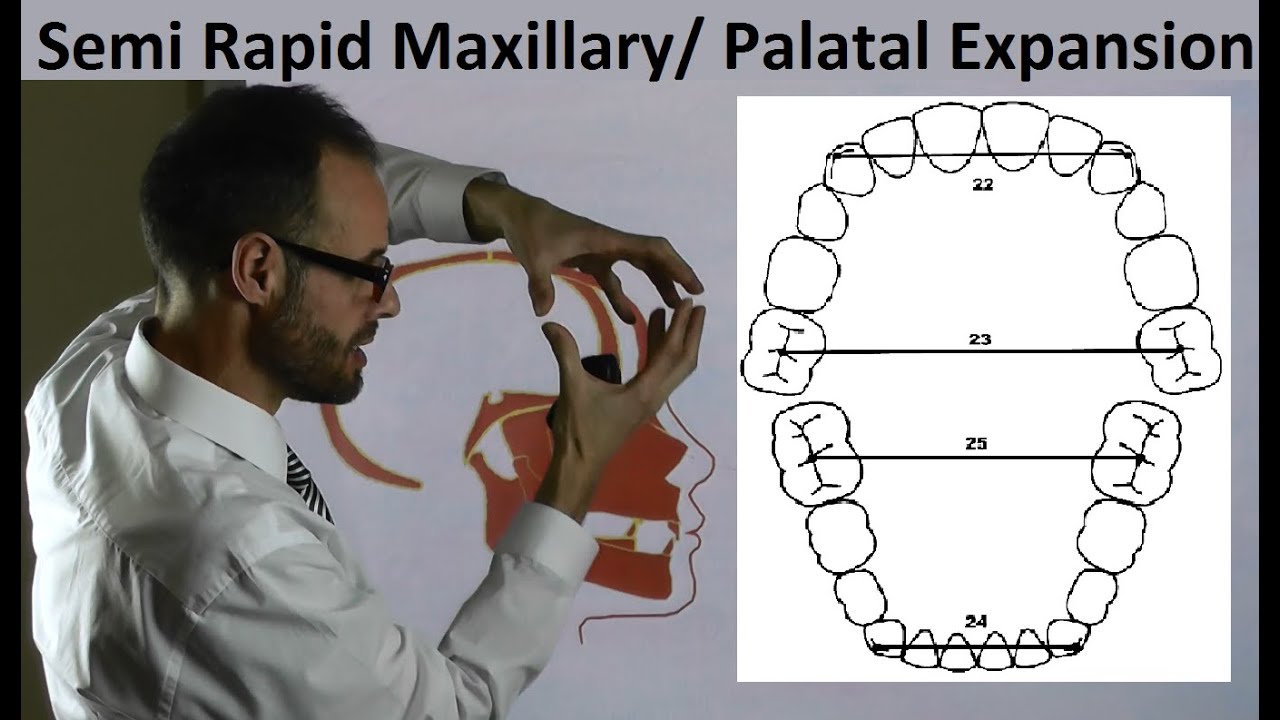 Mechanism of Semi Rapid Palatal/ Maxillary Expansion & Teeth Position on Arches by Dr Mike Mew