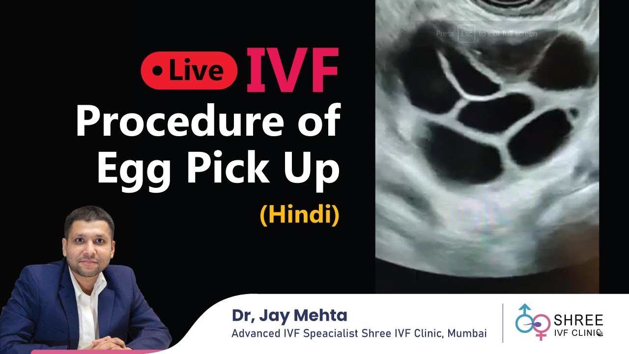 LIVE IVF Procedure of Egg Pick Up (Hindi) | Oocyte Retrieval | Dr Jay Mehta, Mumbai | IVF in Hindi