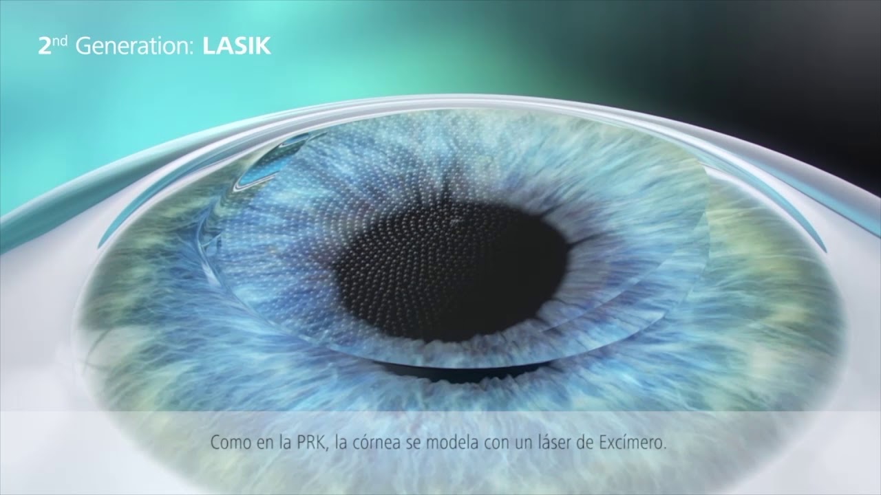 Cirugía refractiva -  PRK FEMTO LASIK  y SMILE - Clínica Tecnoláser