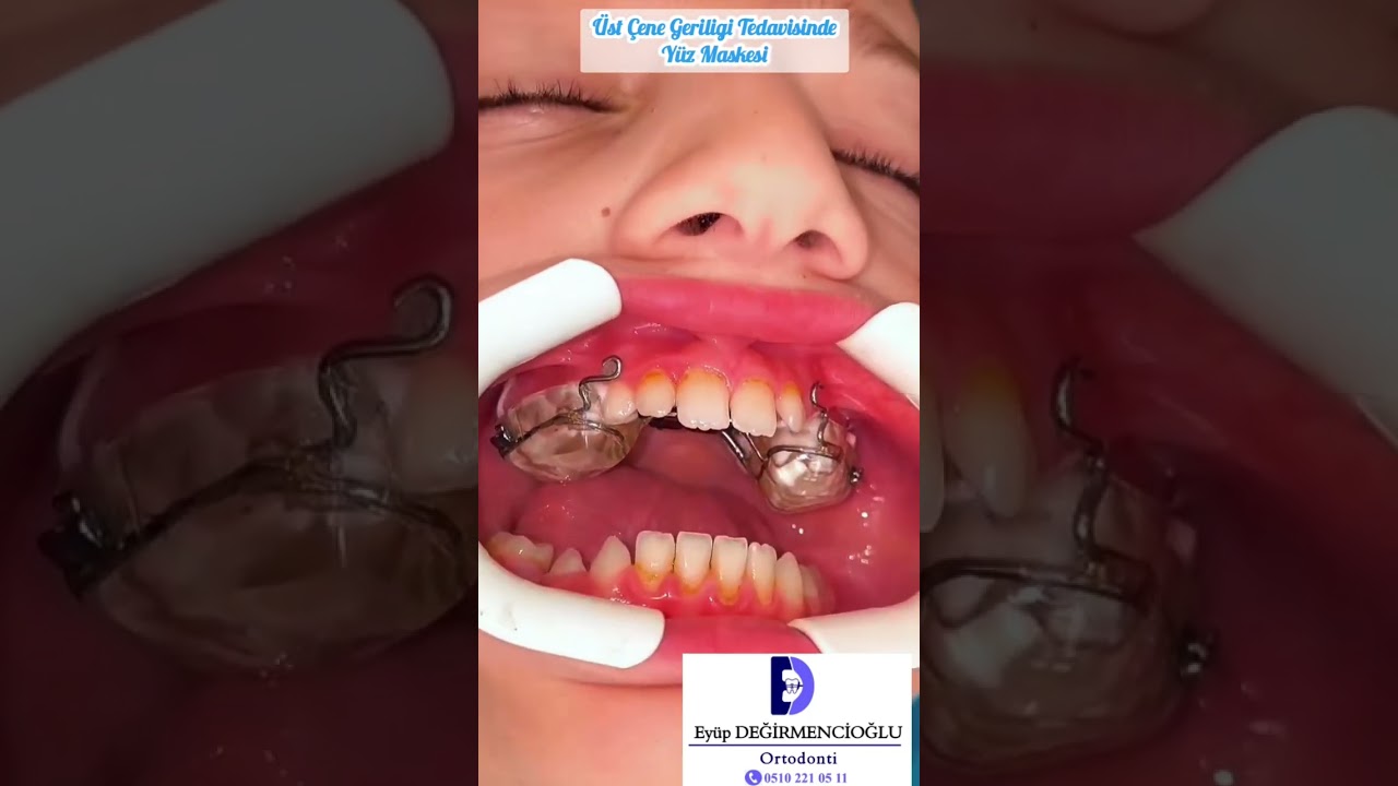 &Uuml;st &Ccedil;ene Geriligi Tedavisinde Y&uuml;z Maskesi#orthodontist #ortodontist #ortodonti #şeffafplak #dişteli