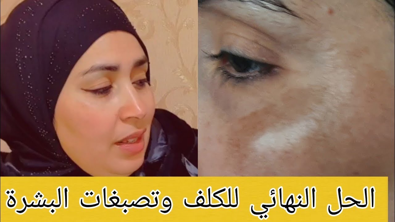 من بعد معانات معا لكلف وأخيرا لقيت الحل لي صدمني بنتيجة 😍 علاج  و البقع السوداء