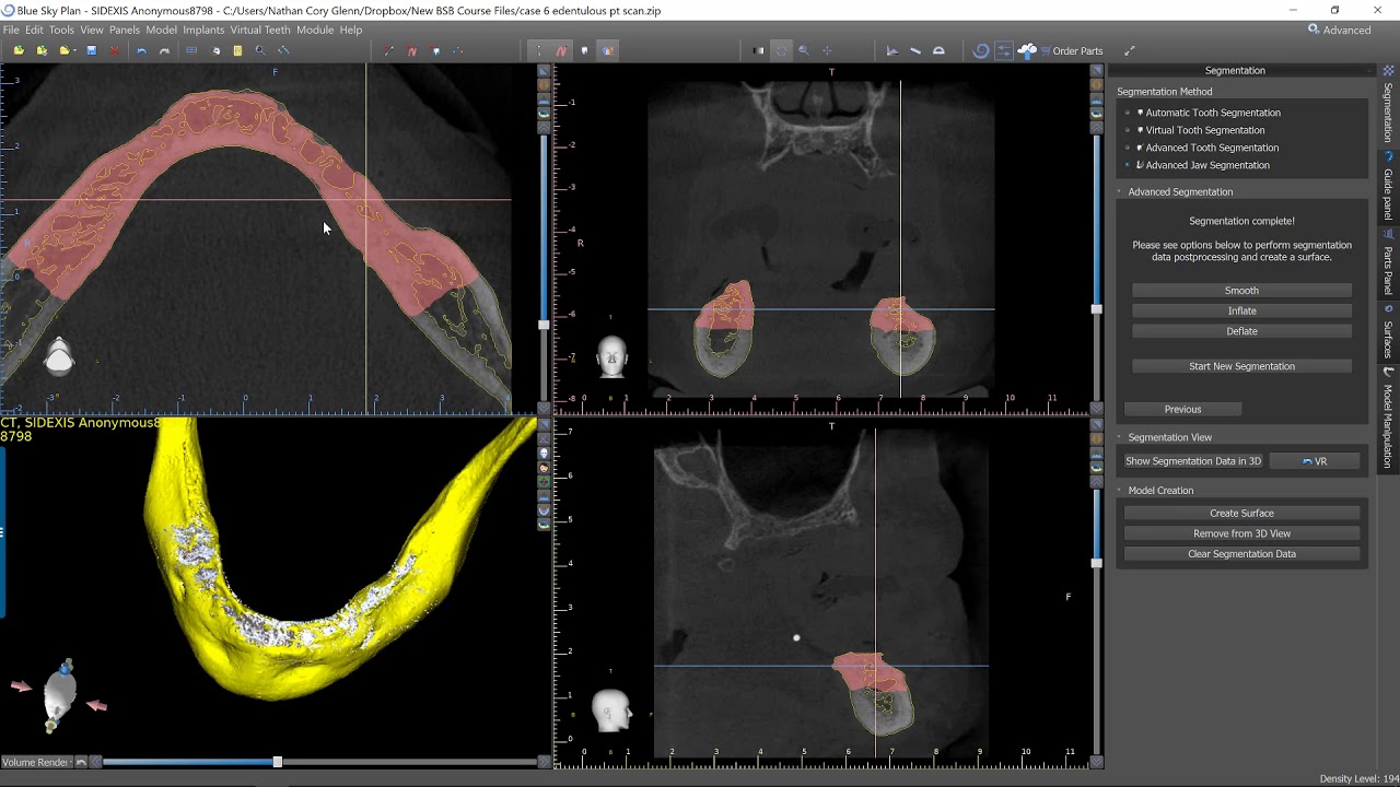 Bone Segmentation Using Blue Sky Plan