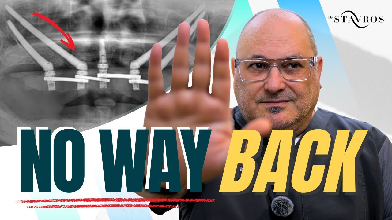 Zygomatic Implants: The Point of No Return in Full-Arch Surgery