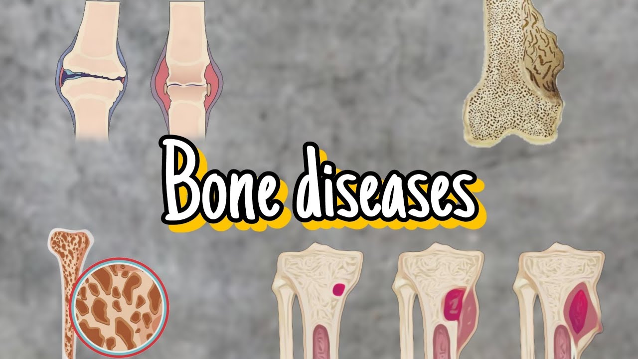 bone diseases