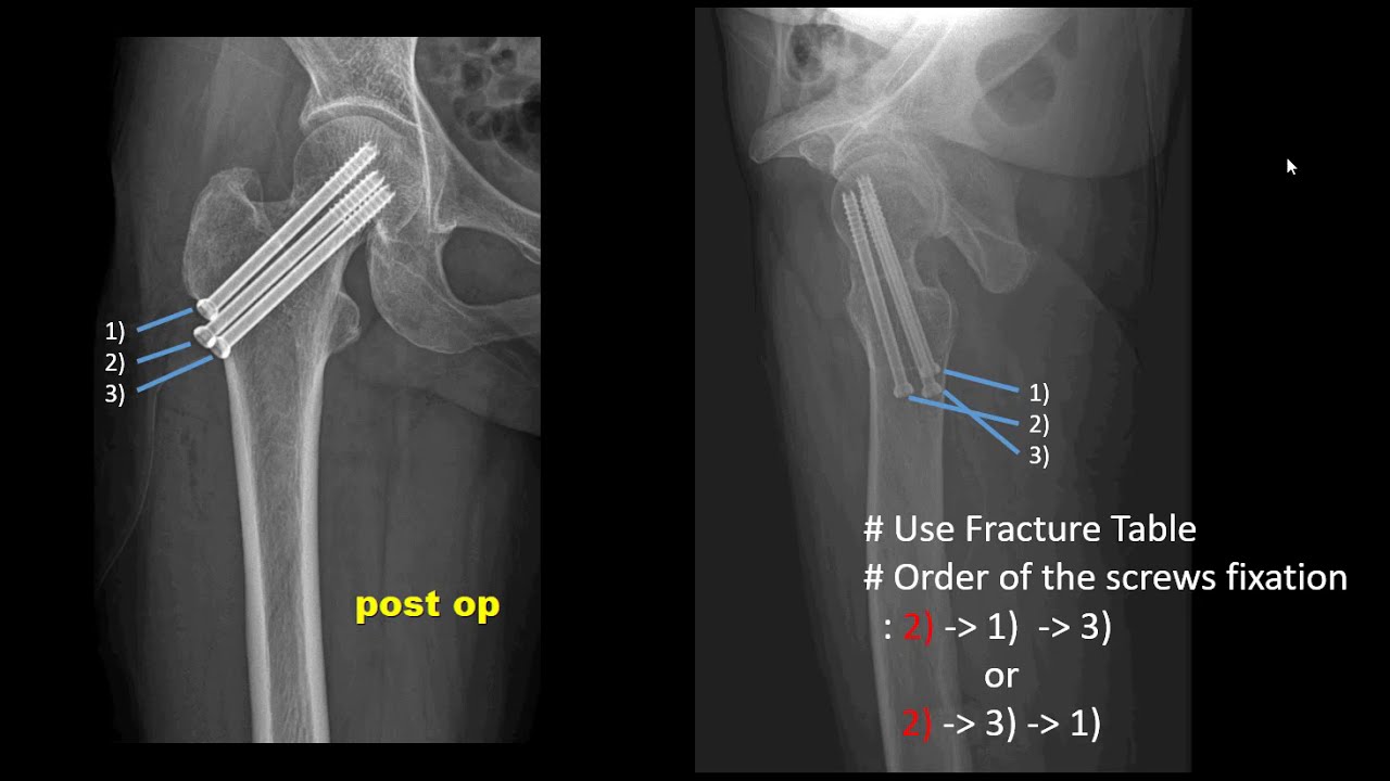 femur neck fracture,  order of screw fixation