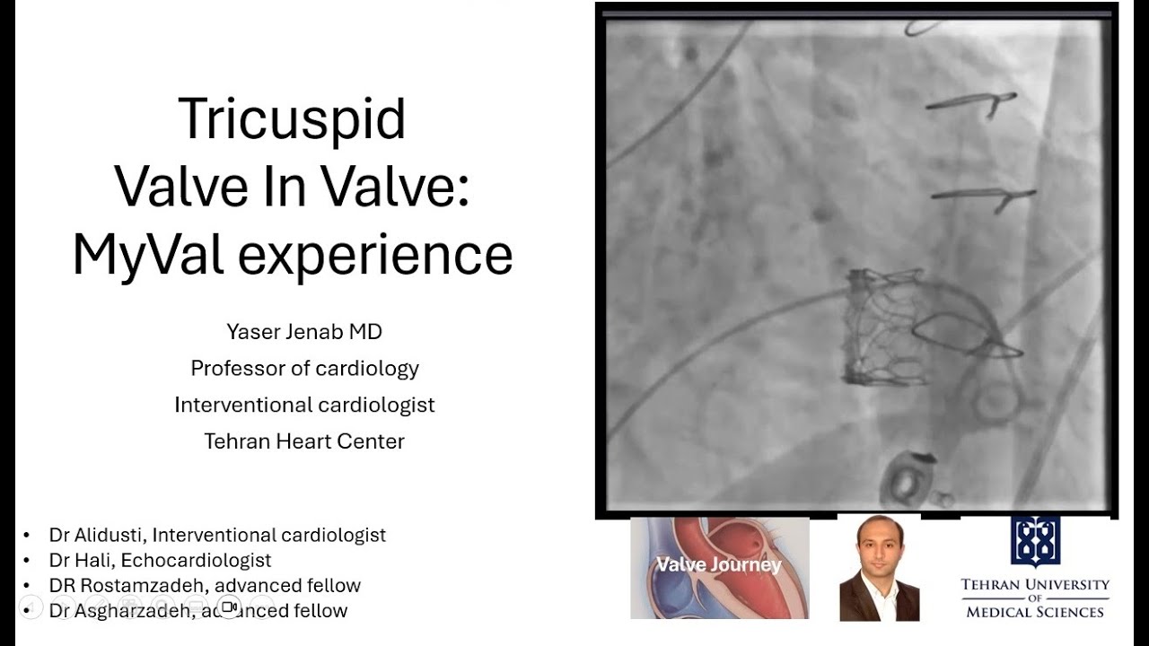 Tricuspid Valve In Valve: MyVal experience