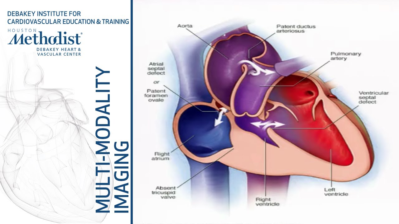 Congenital Heart Disease: A Primer for the Imager (C. Huie Lin, MD, PhD) June 11, 2019
