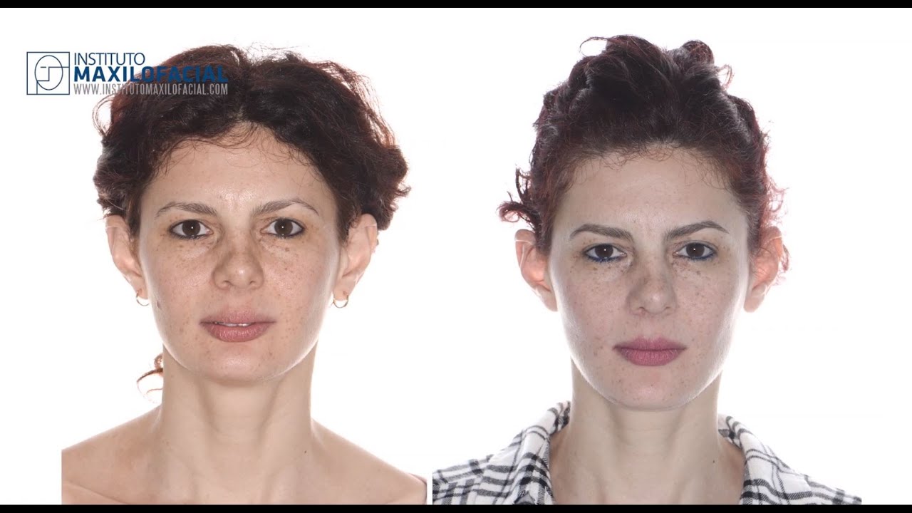 Cirugía ortognática monomaxilar. Caso #52: Nazly - Clase 2, sobremordida