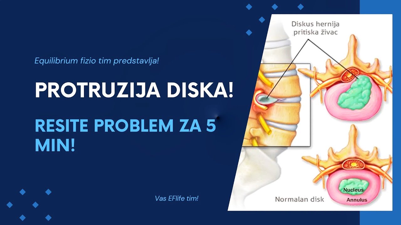 Protruzija diska - REŠITE PROBLEM ZA 5 min!