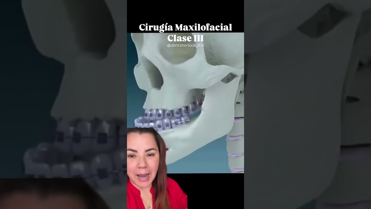 💥 Transformación con CirugMaxilofacial Clase III