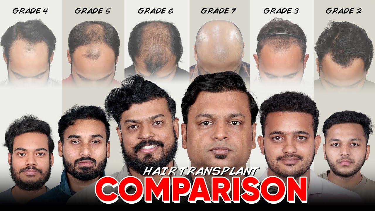 Hair Transplant in India | Best Results & Cost of Hair Transplant in India