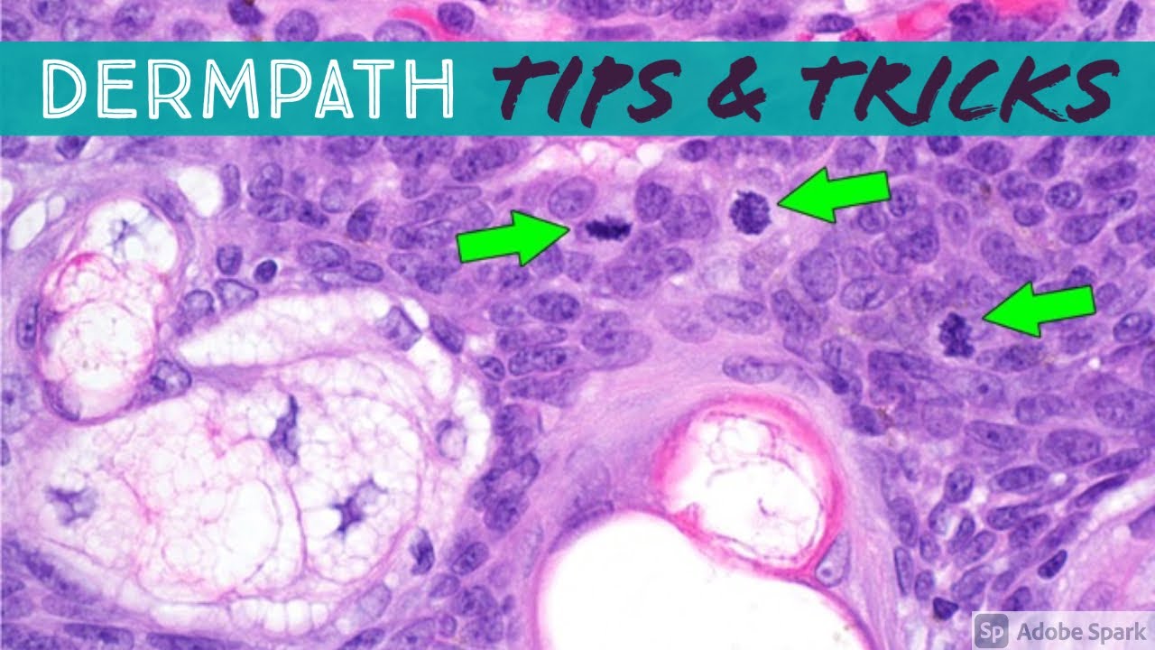 Dermatopathology: Practical Tips & Tricks for Pathology & Dermatology