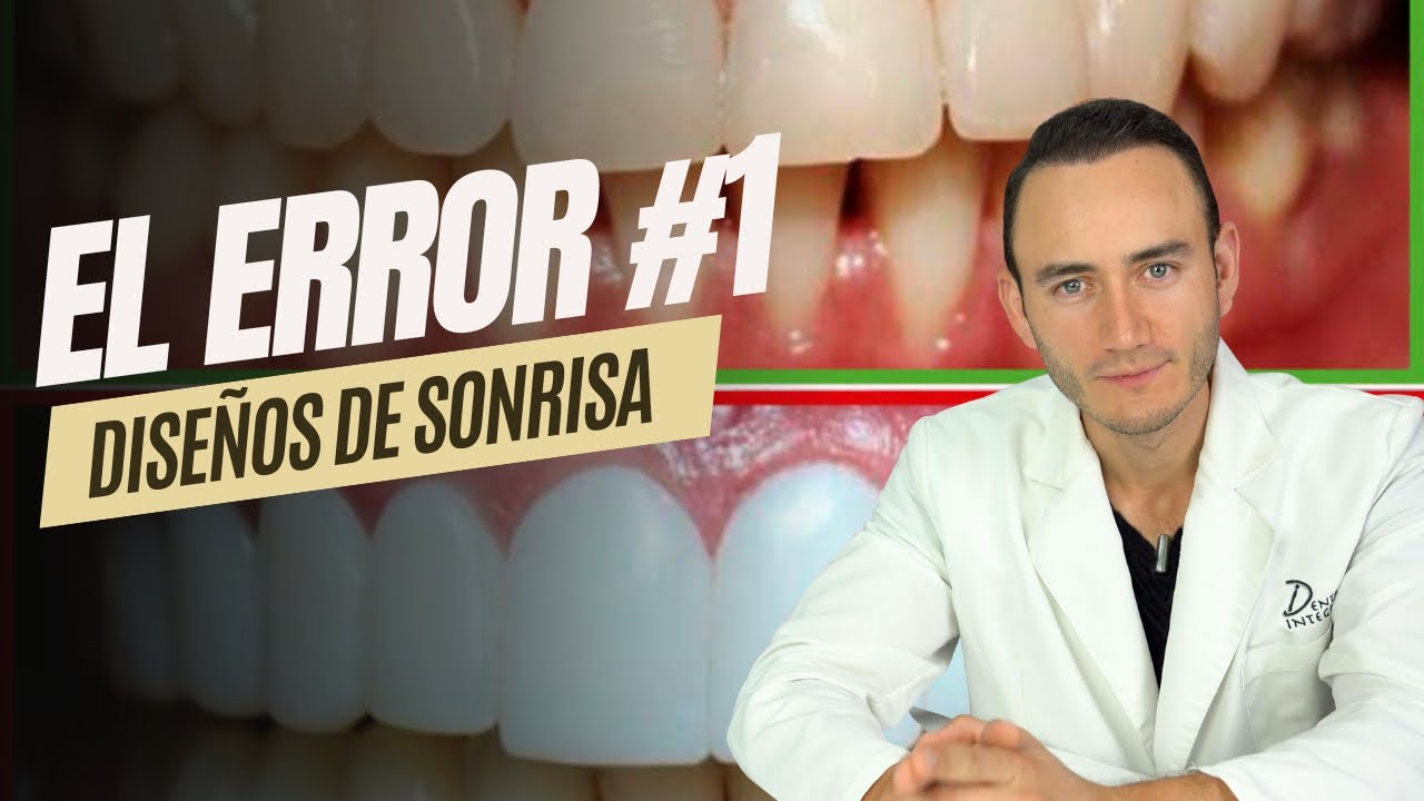 El error #1 en un Diseño de Sonrisa