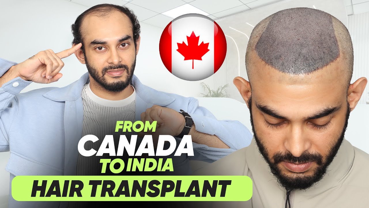 Hair Transplant in Hyderabad (HX-DGET) | Best Results & Cost of Hair Transplant in Hyderabad.