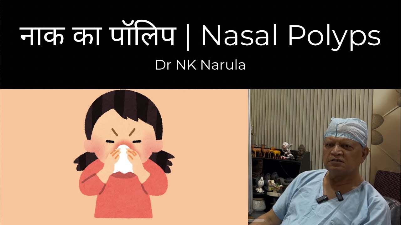 नाक का पॉलिप | Nasal Polyps | Dr NK Narula