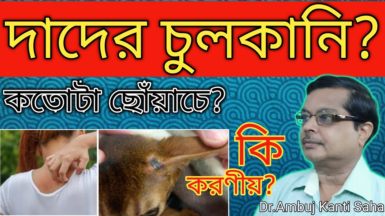 Ringworm & Hot weather | Best Homeopathic Medicine for Fungal Infection Ringworm\ tinea corporis