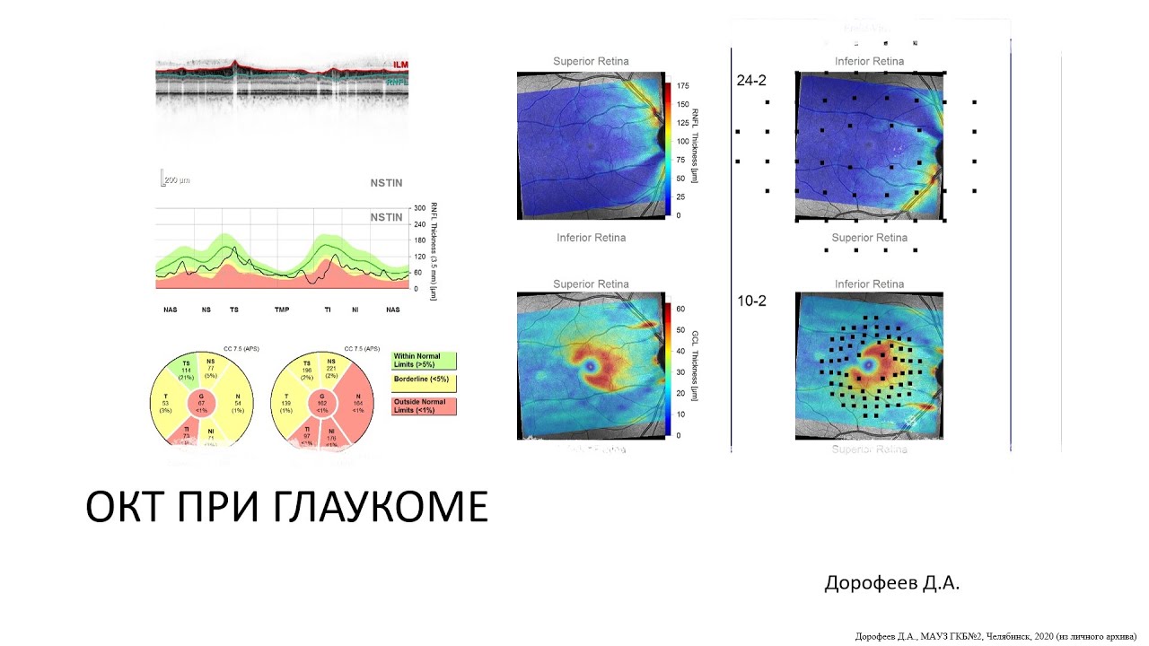 Основы ОКТ при глаукоме 1/7