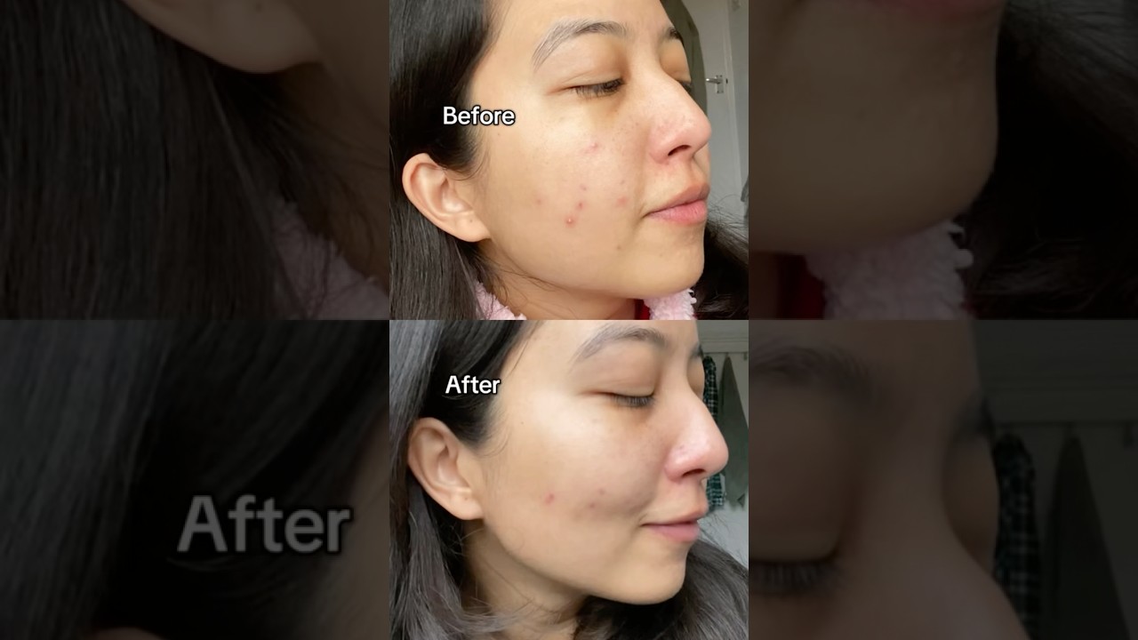 Dr. Althea 345 relief cream. Results after one month #shorts #skincarereview #koreanskincare