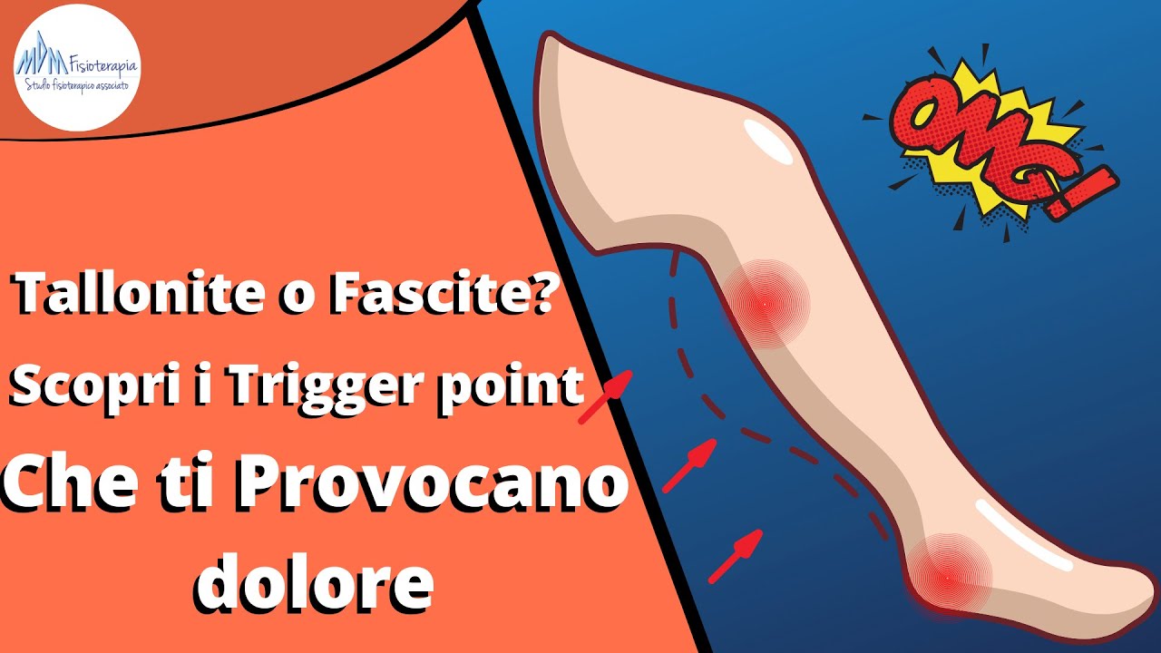 Tallonite e fascite plantare | Quali sono i trigger point del Polpaccio che possono scatenarla
