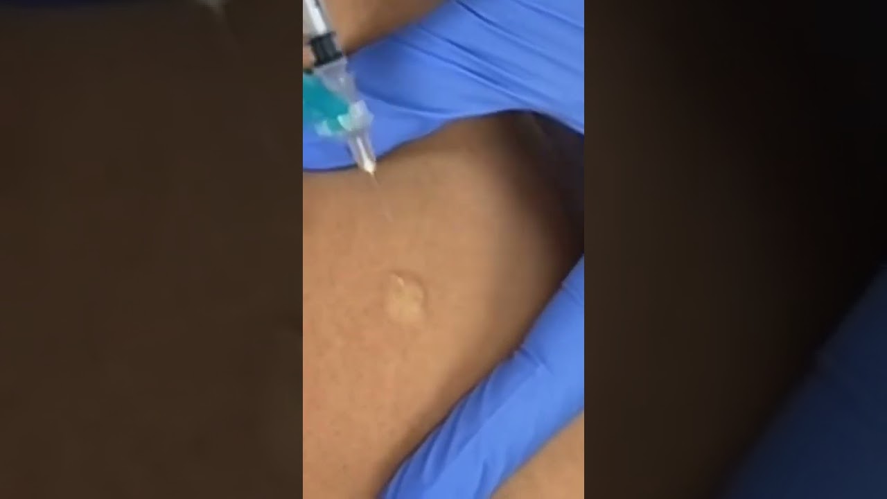 How to Give an Intradermal #Injection 💉 #TBTest #PPD #MedicalAssistant