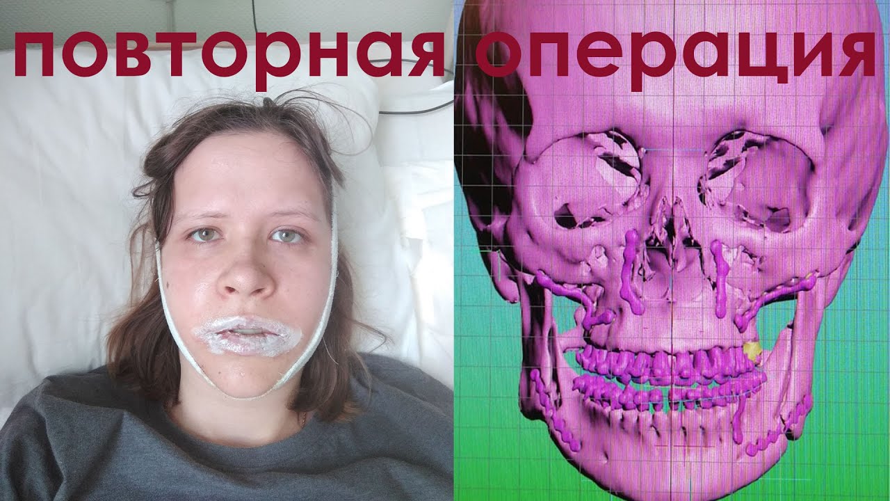 Зубные новости. Повторная операция и реабилитация. 3 недели ПОСТОП