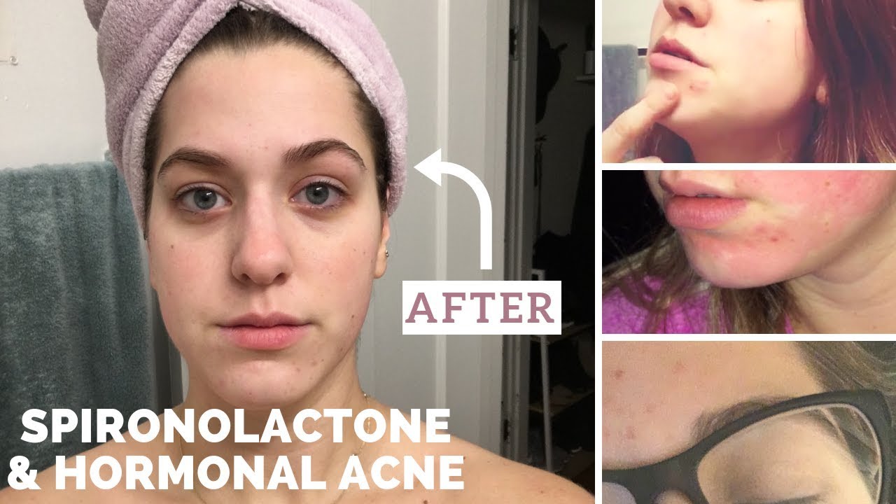 Spironolactone for Hormonal Acne: My Experience & Thoughts