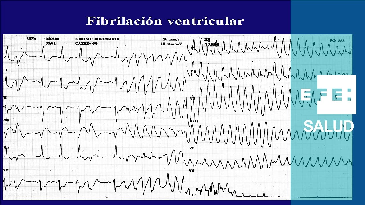 Taquicardia: La fibrilaci&oacute;n ventricular, caos y shock