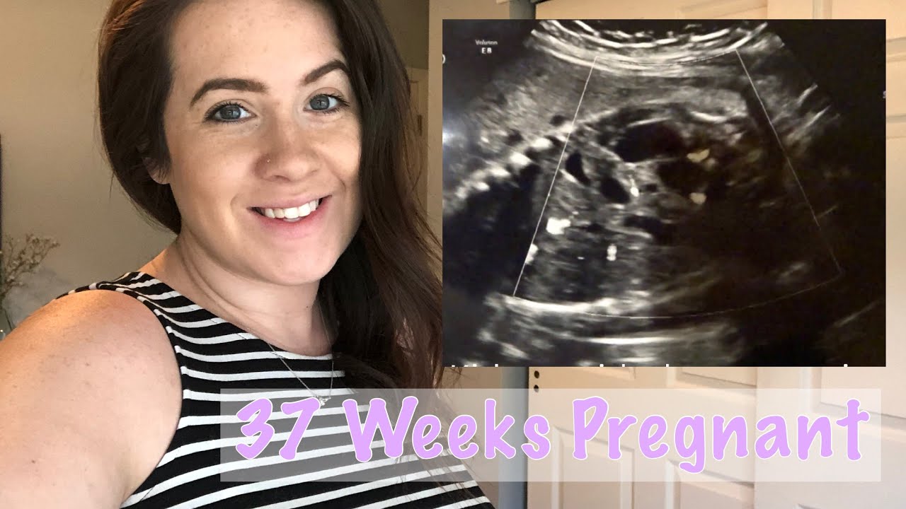 37 WEEKS PREGNANCY UPDATE | MULTICYSTIC DYSPLASTIC KIDNEY UPDATE