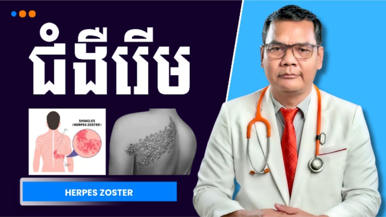 ជំងឺរើម-Herpes Zoster