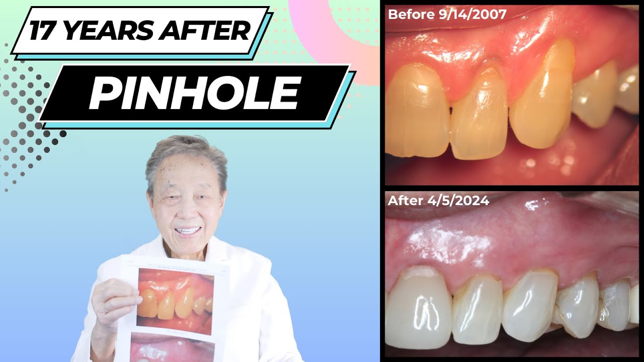 Transforming Smiles. A Deep Dive into the Pinhole&reg;: 17-Year-old Case Review