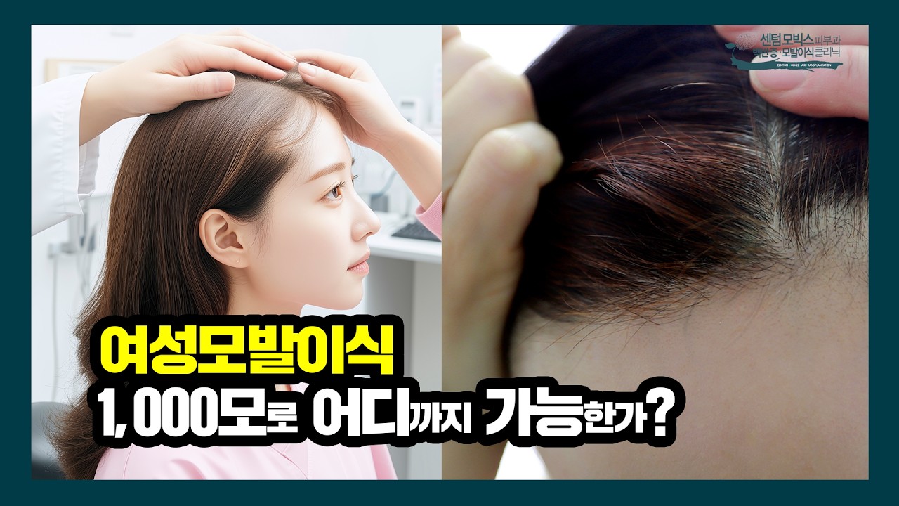 여성모발이식, 1000모로 어디까지 이식이 가능한가?