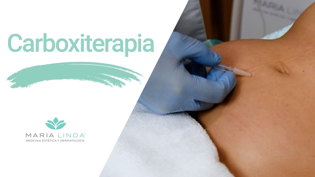 Disminuye FLACIDEZ, ESTRÍAS y CELULITIS con Carboxiterapia | María Linda
