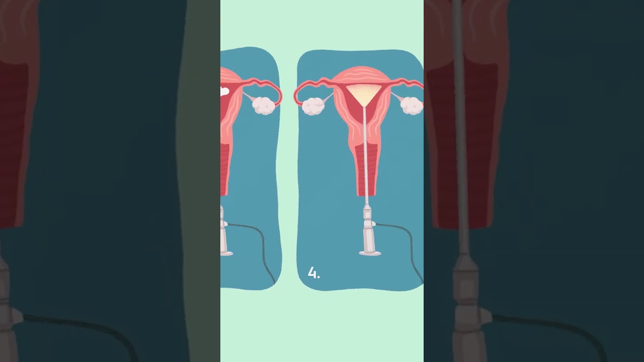 HYSTEROSCOPY