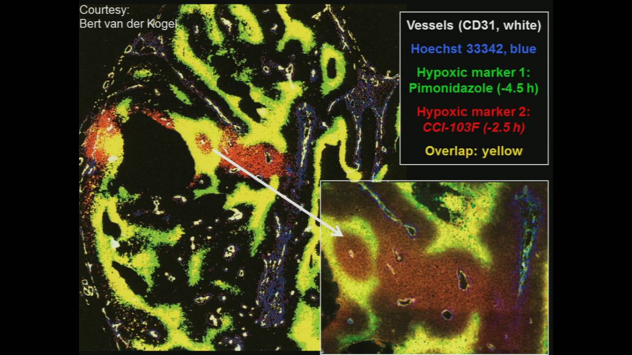 SRS/SBRT - Radiobiology of High Dose Per Fraction - By Michael Joiner, Ph.D
