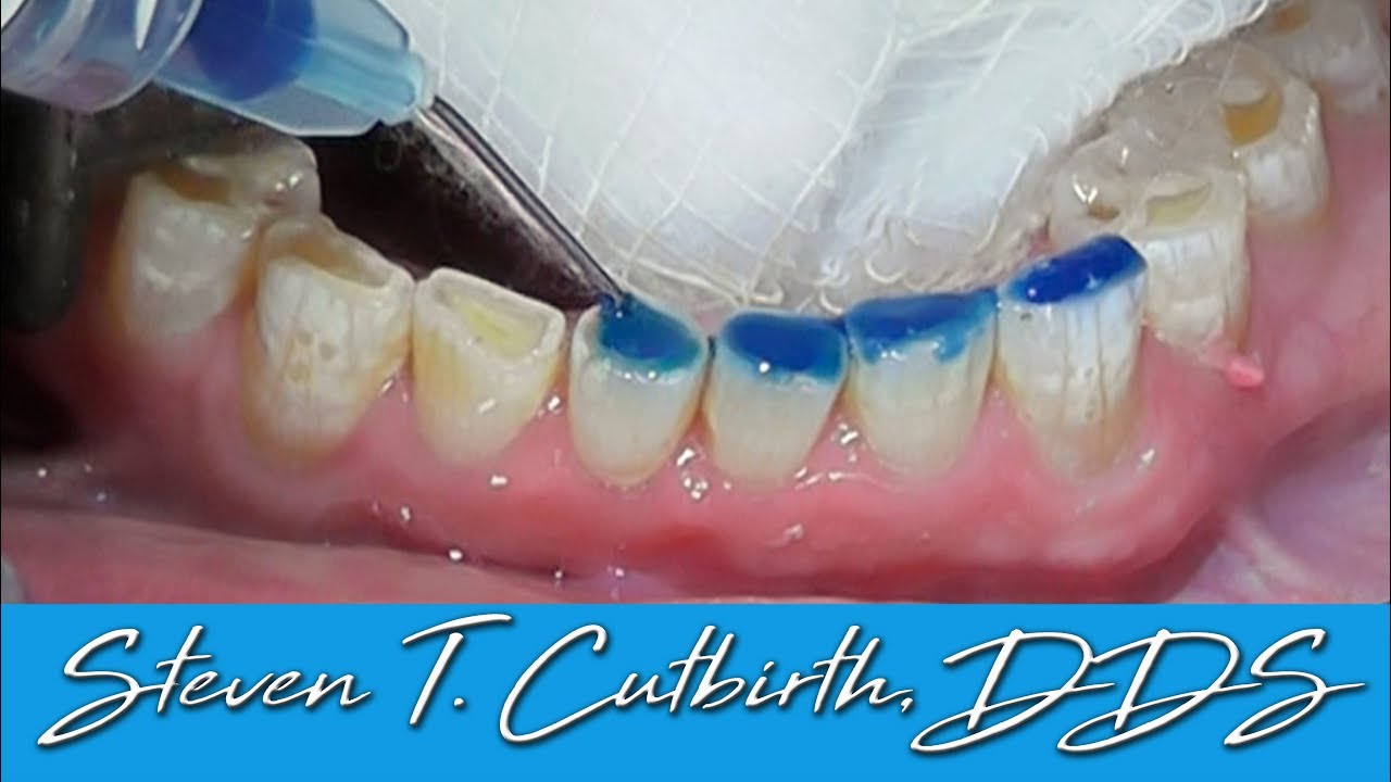 Bonding Worn Anterior Teeth - Dental Minute with Dr  Steven T. Cutbirth, DDS