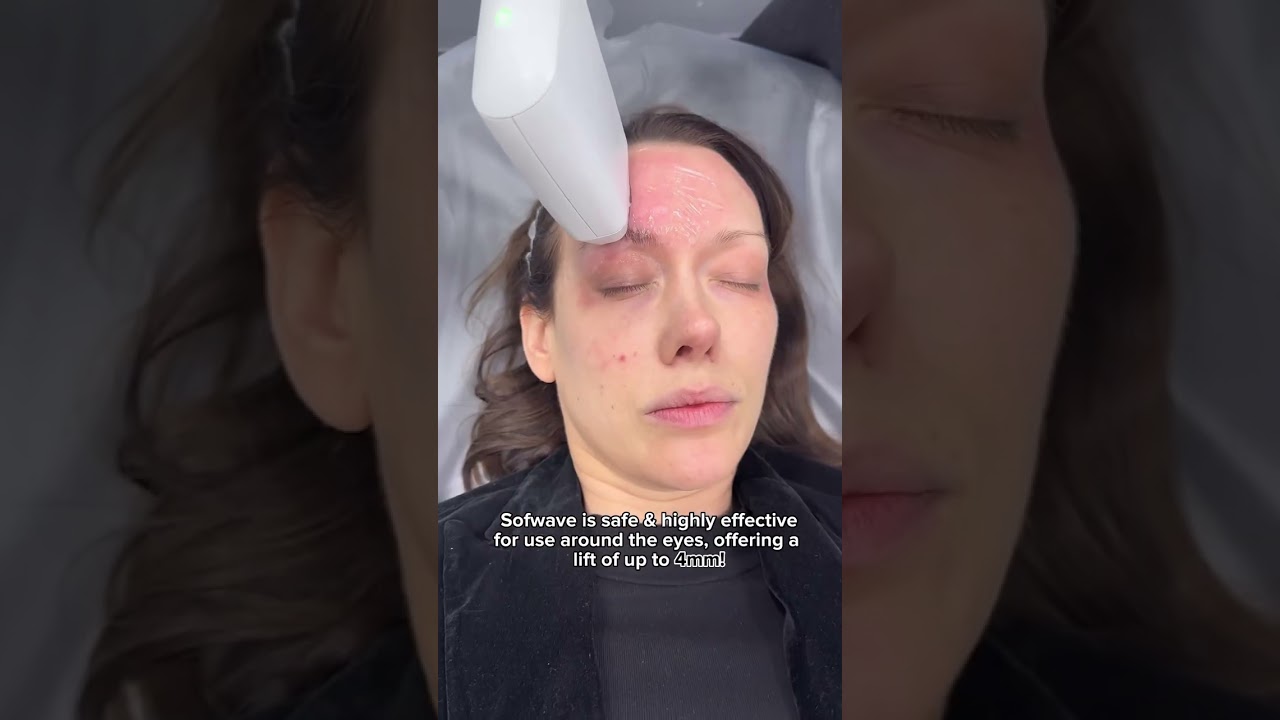 INSTANT non-surgical BROW LIFT with SOFWAVE | Dr. Medispa