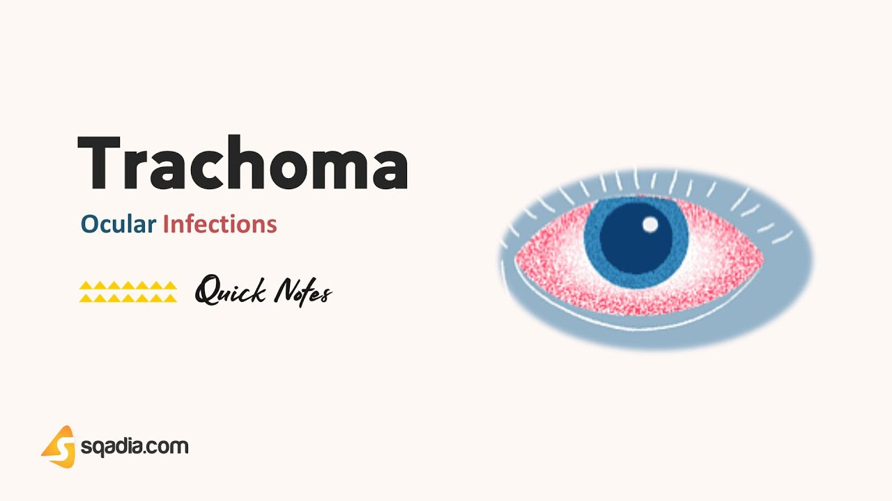 Ocular Infections | Trachoma