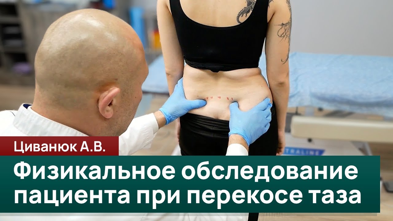 Физикальное обследование пациента при перекосе таза. Циванюк А.В.