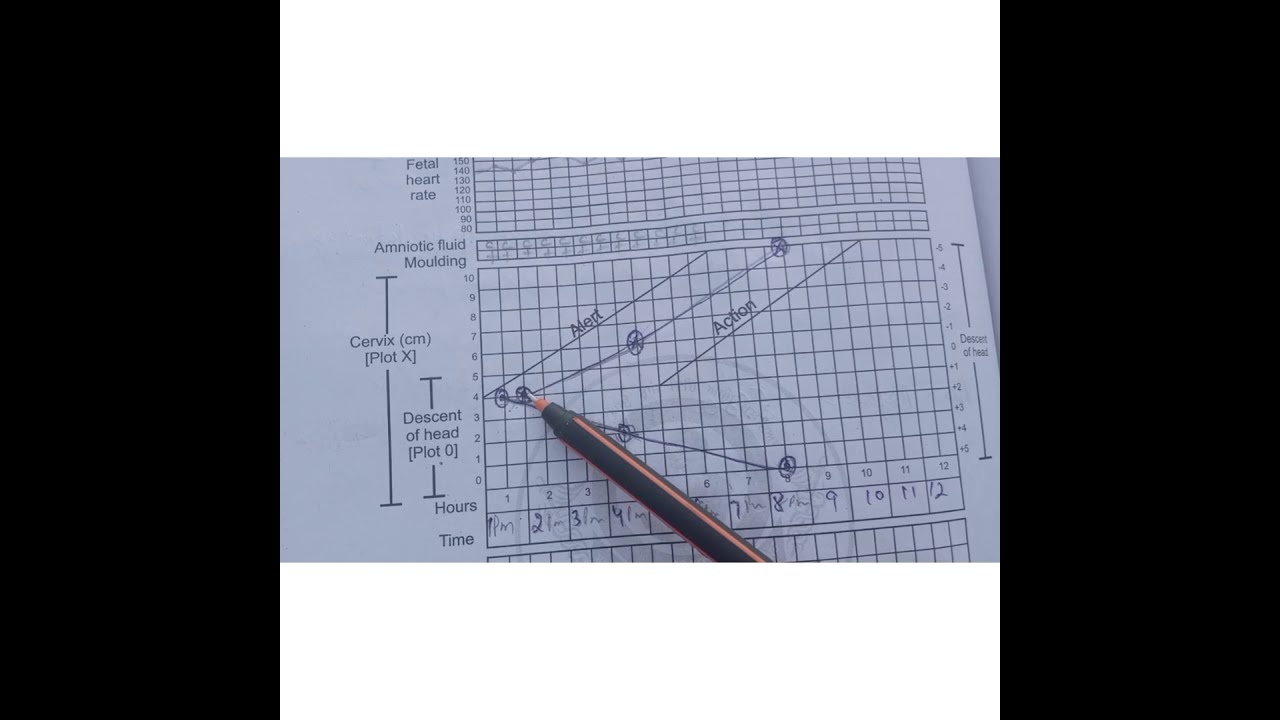 Partograph in Hindi ... partograph kaise fill karien easy trike se...#nursing video